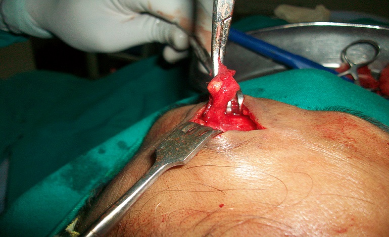 Surgical removal of Forehead mass